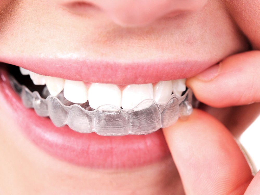 Know about Invisalign