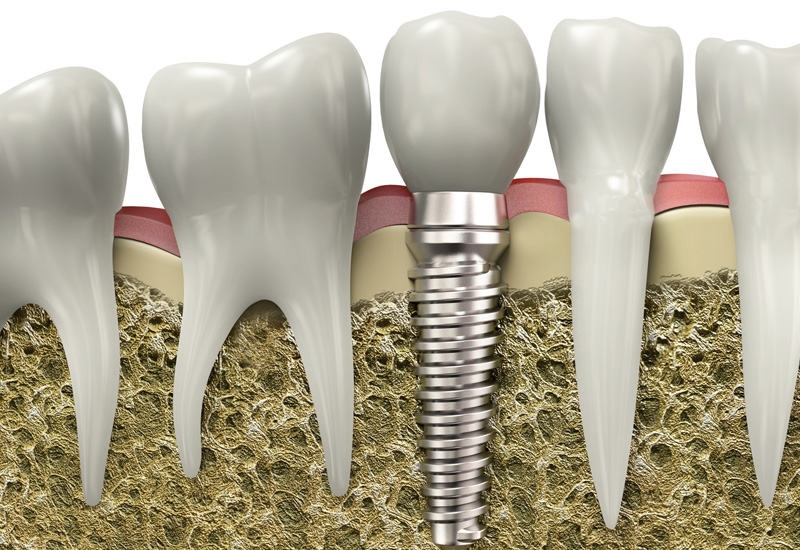 dental implants service in Fort Saskatchewan