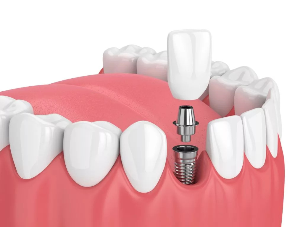 what are full mouth dental implants